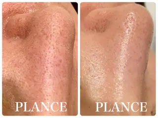 フェイシャル専門 肌質改善/プランスのエステ・リラクイメージ