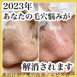 epismoo 脱毛/HBL/毛穴の眉毛・アイブロウイメージ