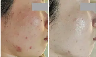 Sha.Lu.Lu.所属・【ニキビ改善】 肌育ハーブピーリングのエステ・リラクイメージ