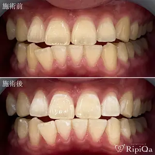 セルフホワイトニング RipiQaのその他イメージ