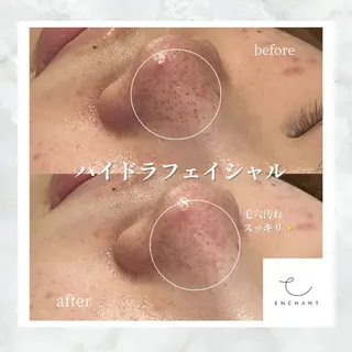 ENCHANT Kaede/肌質改善のその他イメージ