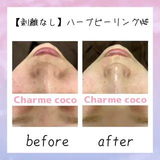 肌質改善Charme coco  みさのエステ・リラクイメージ