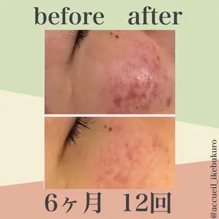 🔥3か月で肌革命 🔥ニキビ専門店のエステ・リラクイメージ