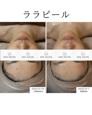 RUPO THE MAINTENANCE新潟店【ローマピンク公式認定店/ララピール正規店/骨格小顔】所属・オーナー Nanjoのエステ・リラクイメージ