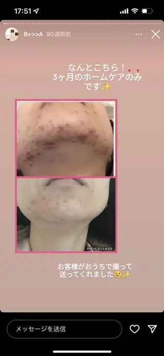 皮膚科より効果あり ⁉️最短ニキビ改善のエステ・リラクイメージ