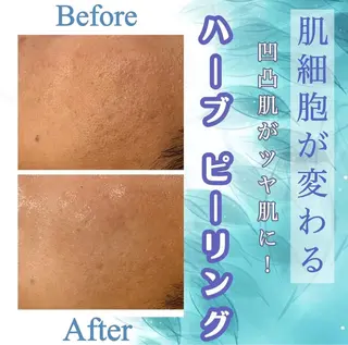 Meow！～トラブル肌専門ピーリング＆脱毛サロン～所属・トラブル肌改善🏥 Meow！🫧🫧のエステ・リラクイメージ