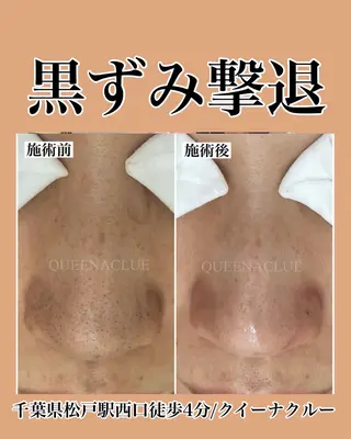 毛穴改善/脱毛 ネイル　川上久仁子のエステ・リラクイメージ