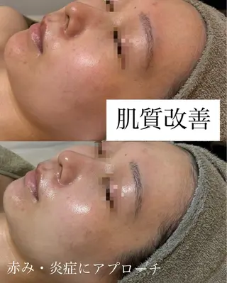 肌質改善専門サロンAte国分寺店所属・Ate Rikaのエステ・リラクイメージ