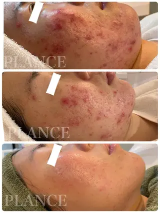 フェイシャル専門 肌質改善/プランスのエステ・リラクイメージ