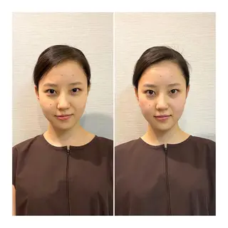 即小顔♥️美容鍼× ハーブピーリングのその他イメージ