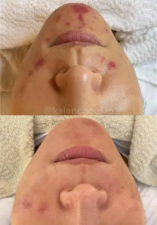 肌質改善 KALANCHOEのエステ・リラクイメージ