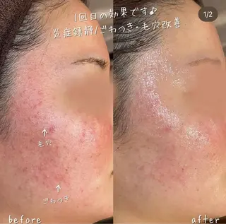 【ハーブピーリング/毛穴洗浄】NA skin 川崎店〜ニキビ・毛穴専門店〜所属・NAskin川崎 皆川のエステ・リラクイメージ