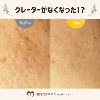 ニキビケア/毛穴/ 赤み/自信の肌✨森園のエステ・リラクイメージ