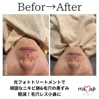 Meupニキビ専門店 背中/ハーブ/ララのその他イメージ