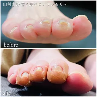 ネイル 深爪・巻き爪 専門サンセリテのネイルデザイン