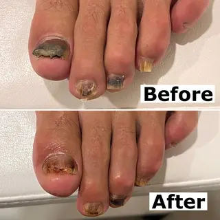 ネイル Mellow nail所属・巻爪無料モデル募集 ✨🦶MEGUMIのネイルデザイン