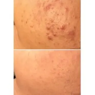 ニキビ特化型エステ 🍓最短で肌質改善のエステ・リラクイメージ