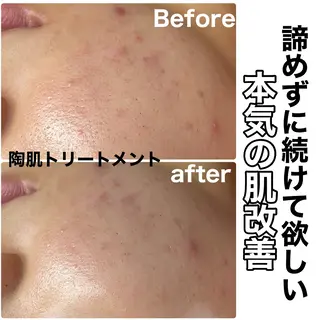 Chalon所属・REVI取扱・肌悩み 改善　Chalonのエステ・リラクイメージ
