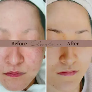 beauty & health salon Chou chou所属・ニキビ・毛穴🌿肌を 育てるララピール✨のエステ・リラクイメージ