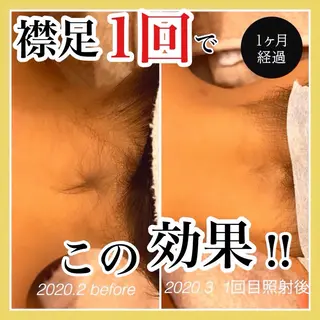 メンズ キッズ epismoo 脱毛/HBL/毛穴の眉毛・アイブロウイメージ