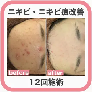 ニキビ特化型エステ 🍋最短で肌質改善のエステ・リラクイメージ