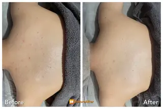 Meupニキビ専門店 背中/ハーブ/ララのその他イメージ