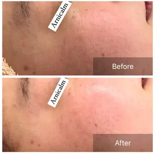 ハーブピーリング 肌再生ピーリング/のエステ・リラクイメージ