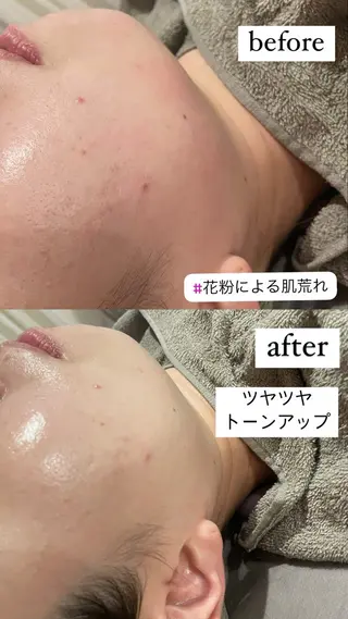 Meupニキビ専門店 背中/ハーブ/ララのその他イメージ