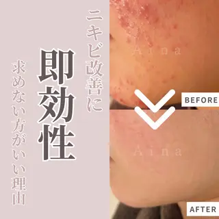 ニキビ跡専門サロン Ainaのエステ・リラクイメージ