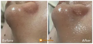 Meupニキビ専門店 背中/ハーブ/ララのその他イメージ