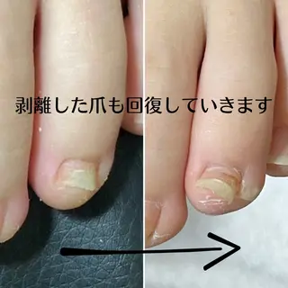 ネイル 深爪・巻き爪 専門サンセリテのネイルデザイン