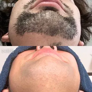 メンズ 脱毛 Beauty salon Lumiere(ルミエール)所属・完全都度払い脱毛⭐︎ Lumiereのエステ・リラクイメージ