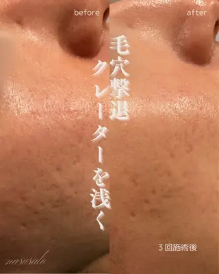 肌育×小顔×毛穴洗浄 ナスサロ 看護師只野のエステ・リラクイメージ