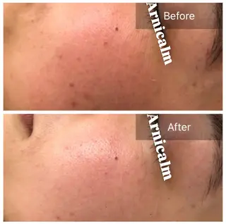 ハーブピーリング 肌再生ピーリング/のエステ・リラクイメージ