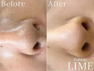 ハーブピーリング LIME池袋東口のエステ・リラクイメージ