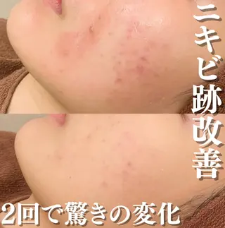 ニキビ跡改善専門🔥 医療にはできない改善のエステ・リラクイメージ