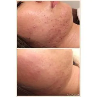 ダウンタイムなし✨ 敏感肌さん用エステのエステ・リラクイメージ