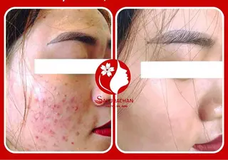 ニキビ、痩身、脱毛、 サクラチャンスパのエステ・リラクイメージ