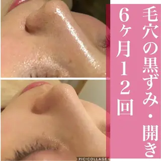 学生ニキビ改善🍀 優しい肌質改善のエステ・リラクイメージ