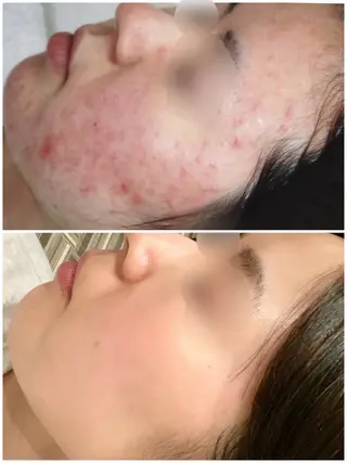 パーソナル肌質改善 🦋APRI🅿️有のエステ・リラクイメージ