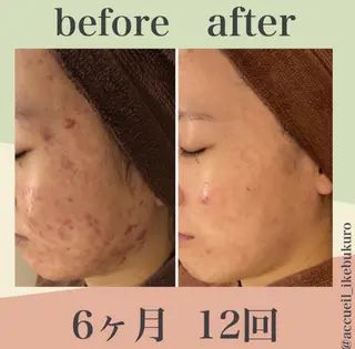 皮膚科より効果あり ⁉️最短ニキビ改善のエステ・リラクイメージ