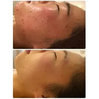 ニキビ特化型エステ 🍓最短で肌質改善のエステ・リラクイメージ