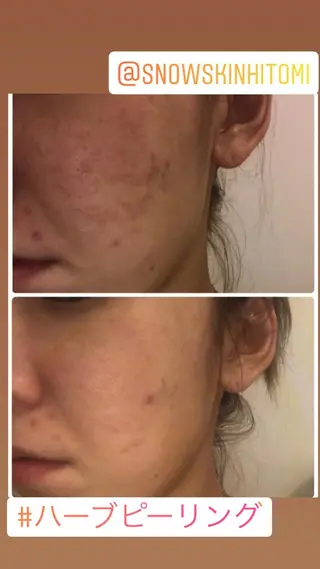 ニキビ/肌質改善専門 Snow skinのエステ・リラクイメージ