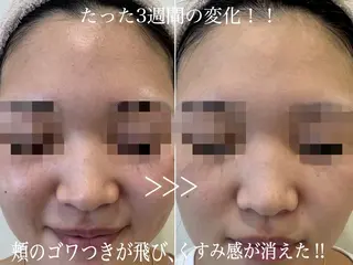 beauty salon Fee所属・毛穴開き黒ずみ ニキビ特化サロン◎のエステ・リラクイメージ
