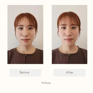 即効⚡小顔美容鍼🪡 むくみたるみ脂肪解消のエステ・リラクイメージ