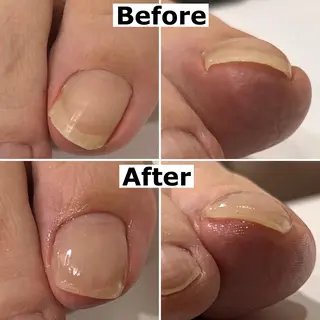 ネイル Mellow nail所属・巻爪無料モデル募集 ✨🦶MEGUMIのネイルデザイン