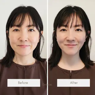 即効⚡小顔美容鍼🪡 むくみたるみ脂肪解消のエステ・リラクイメージ