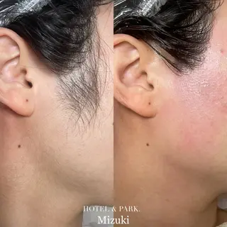 HOTEL&PARK . ワックス脱毛のエステ・リラクイメージ