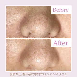 毛穴ケア専門サロンアンスリウム所属・茨城土浦 つくば毛穴 ケア専門サロンのエステ・リラクイメージ