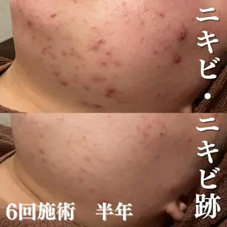 学生ニキビ改善🍀 優しい肌質改善のエステ・リラクイメージ